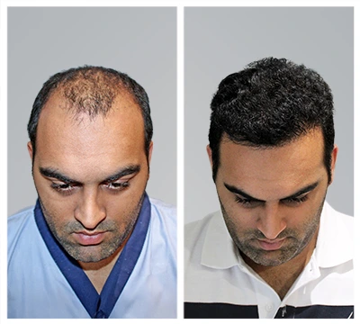 Best Hair Transplant Surgeon in India: Transforming Confidence with Advanced Solutions