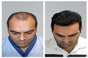 Why DHR Hair Transplant Is Getting More Popular for Cosmetic Surgery in Jodhpur?