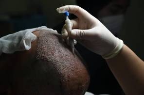 Why DHR Hair Transplant in Jodhpur Is Slowly Becoming a Preferred Choice for Contemporary Hair Restoration