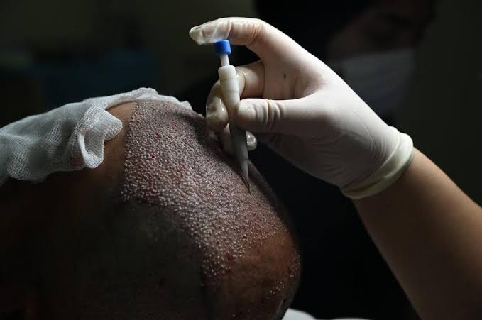 Why DHR Hair Transplant in Jodhpur Is Slowly Becoming a Preferred Choice for Contemporary Hair Restoration