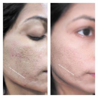 Acne Scar treatment Clinic in Baran