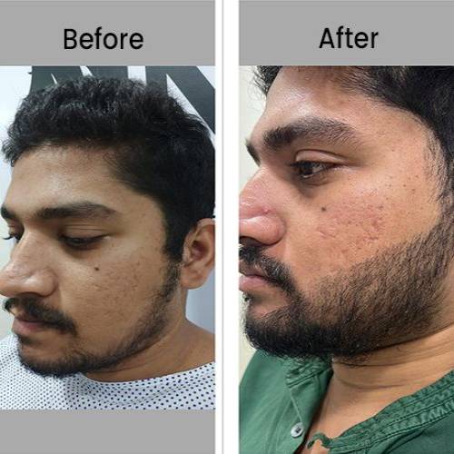 Beard Hair Transplant Clinic in Ganganagar