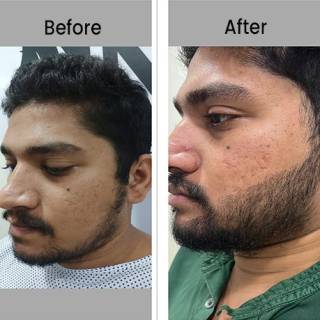 Beard Transplant Clinic in Ganganagar
