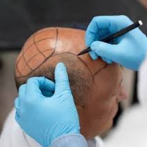 Bio DHT Hair Transplant Clinic in Jodhpur