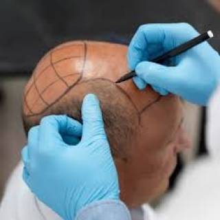 Bio DHT Hair Transplant Clinic in Karauli
