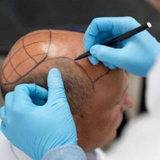 Bio FUE Hair Transplant Clinic in Ganganagar