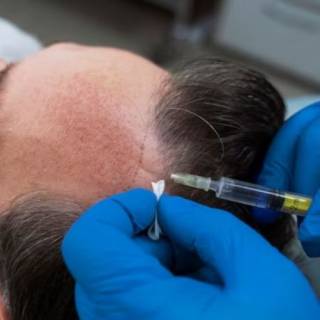 Body Hair Transplant Clinic in Ganganagar
