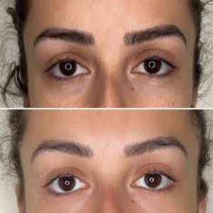 Brow Lift Surgery Clinic in Jodhpur