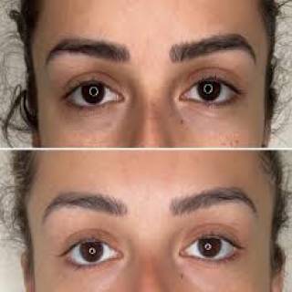 Brow Lift Surgery Clinic in Pachpadra