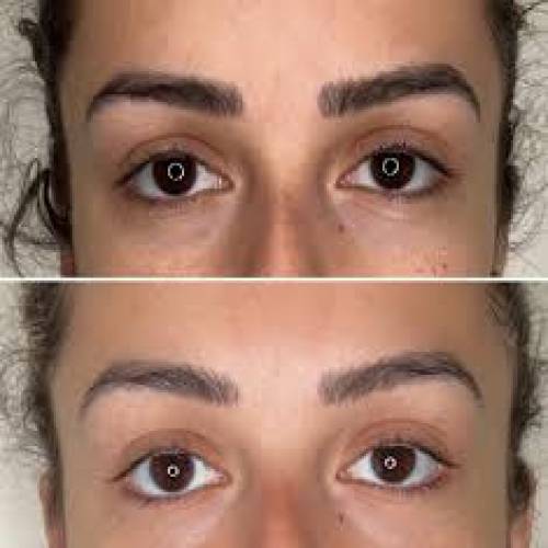 Brow Lift Surgery Clinic in Ramsar