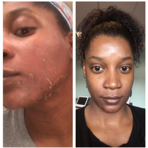 Chemical Peel Treatment Clinic in Ramsar