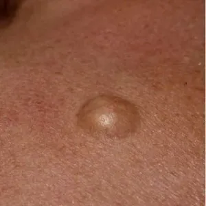 Cyst Removal Clinic in Jodhpur