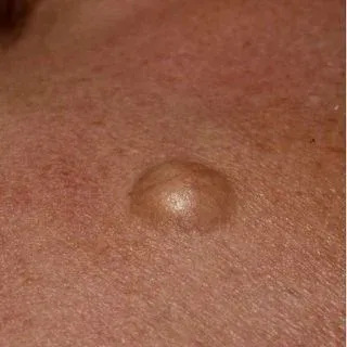 Cyst Removal Clinic in Khushkhera