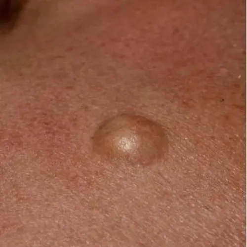 Cyst Removal Clinic in Banswara