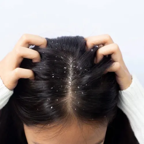 Dandruff Treatment Clinic in Siwana