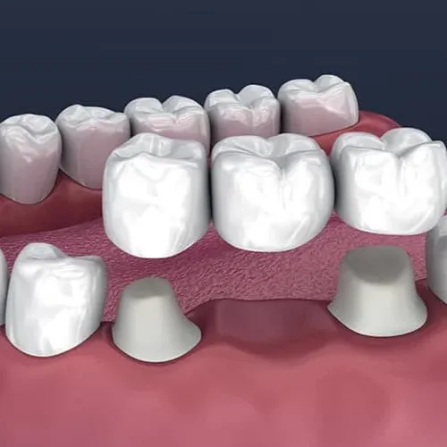 Dental Bridge Treatment Dental Crowns and Bridge Treatment Clinic in Nagaur