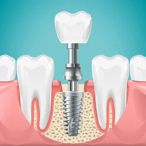 Dental Implants Clinic in Jodhpur