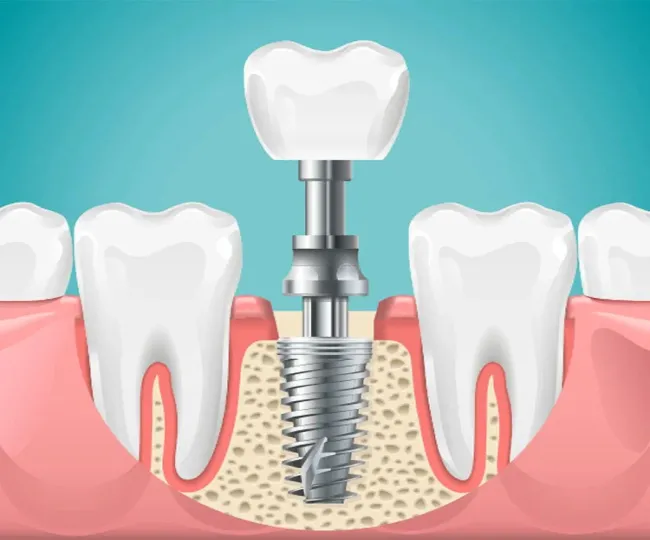 Dental Implants Clinic in Jodhpur