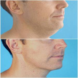 Double Chin Liposuction Clinic in Jodhpur