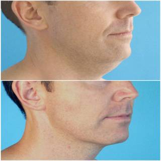 Double Chin Liposuction Clinic in Pachpadra