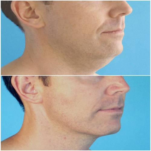 Double Chin Liposuction Clinic in Fatehgarh