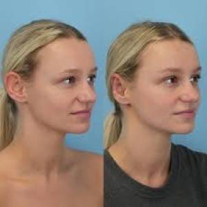 Ear Surgery Otoplasty Clinic in Jodhpur