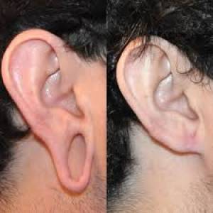 Earlobe Repair Surgery Clinic in Jodhpur