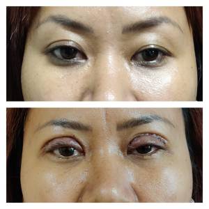 Eyelid Surgery  Clinic in Jodhpur