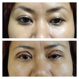 Eyelid Surgery  Clinic in Pachpadra
