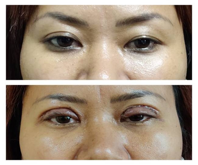 Eyelid Surgery  Clinic in Jodhpur