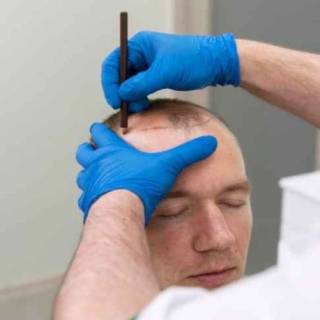 Hair Transplant Cost Clinic in Ganganagar