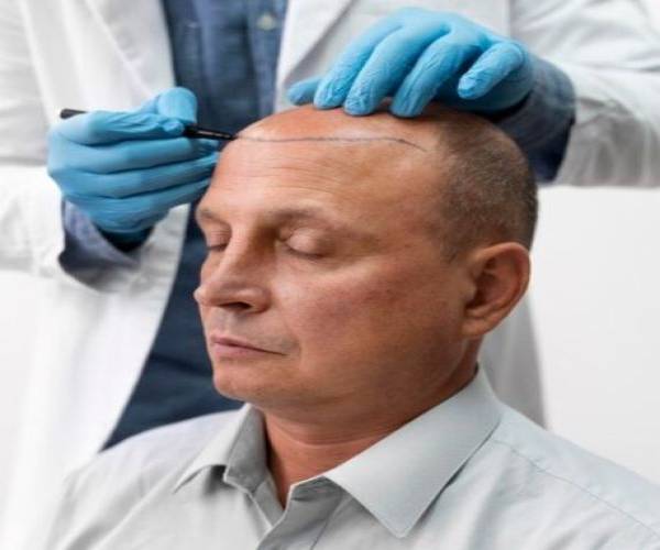 Hair Transplant Clinic in Ganganagar