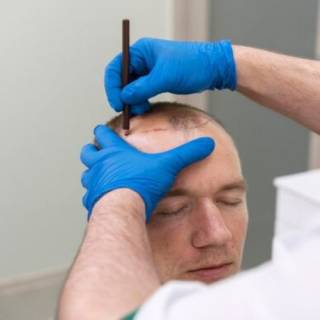 Hairline Reconstruction Clinic in Ganganagar