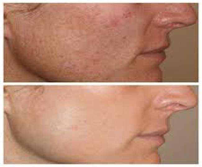 Laser Skin Resurfacing  Clinic in Jodhpur