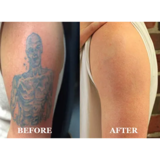 Laser Tattoo Removal Clinic in Banswara