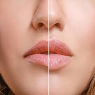 Lip Augmentation Surgery Clinic in Pachpadra