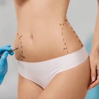 Liposuction Surgery Clinic in Bharatpur
