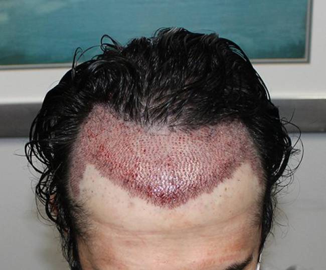 Male Hair Transplant  Clinic in Jodhpur