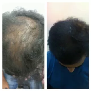 Mesotherapy Treatment for Hair Fall Clinic in Ganganagar