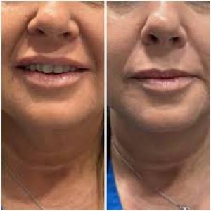 Neck Lift Surgery Clinic in Jodhpur