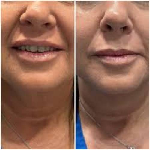 Neck Lift Surgery Clinic in Bilara