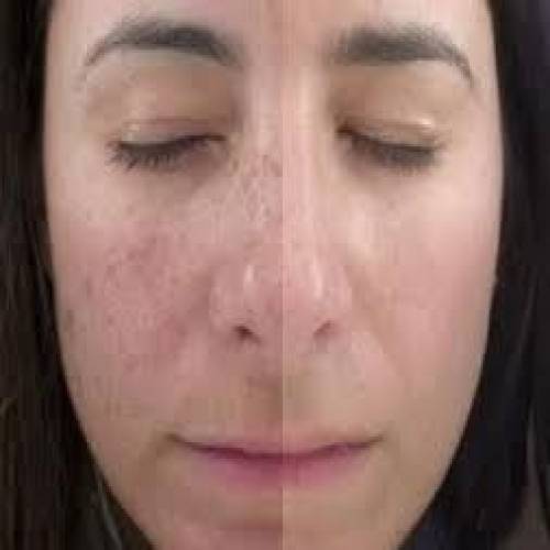 Photofacial Treatment Clinic in Baran