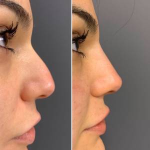 Rhinoplasty Surgery  Clinic in Jodhpur