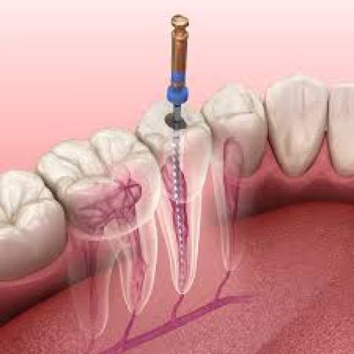 Root Canal Treatment Clinic in Neemrana