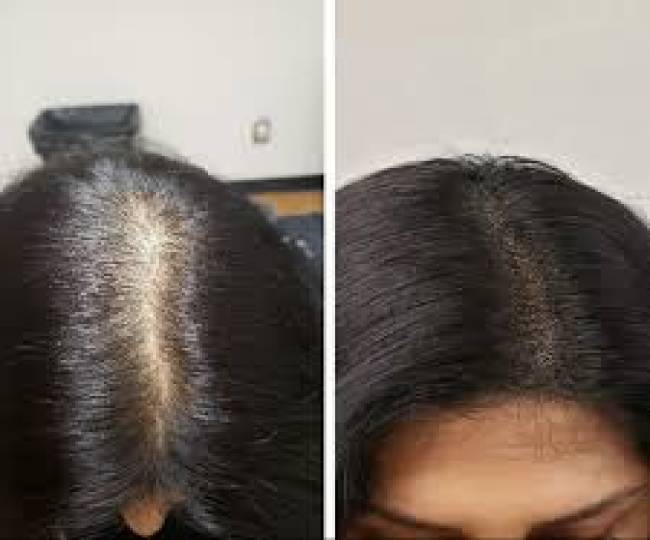 Scalp Micro Pigmentation  Clinic in Jodhpur