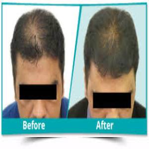 Scalp Rejuvenation Clinic in Jodhpur