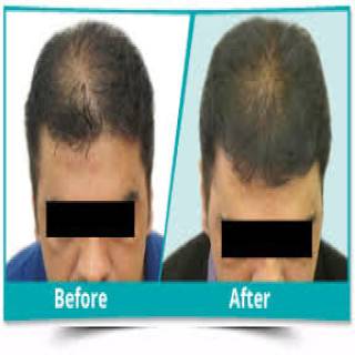Scalp Rejuvenation Clinic in Ganganagar
