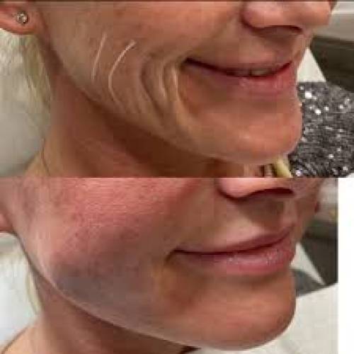 Thread Lift Surgery Clinic in Jaipur