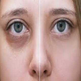 Under Eye Dark Circle Treatment Clinic in Baran