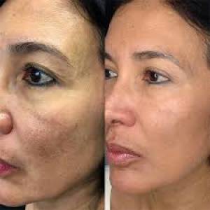 Vampire Facelift Treatment Clinic in Jodhpur